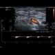 Trombembolus of axillary artery: US - Ultrasound